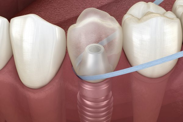 manera-de-limpiar-implantes-dentales